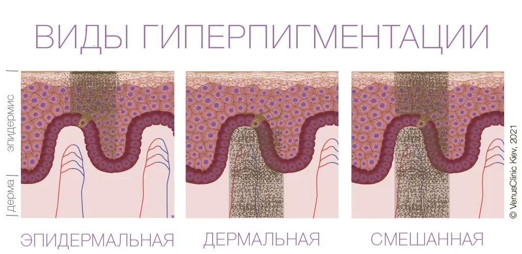 инфографика, виды гиперпигментации кожи