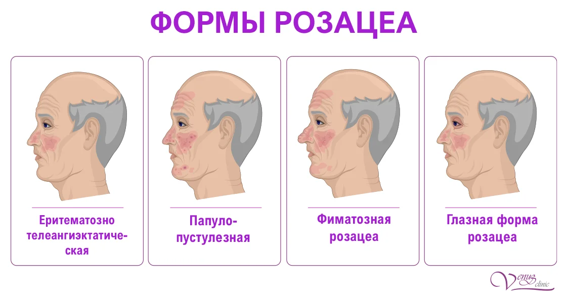 Инфографика 4 стадии розацеа: эпизодическая эритема, телеангиэктазии, папулы-пустулы, фиматозная форма