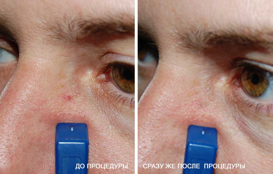 Сосудистая звездочка на лице до и после удаления лазером MedArt VariMed