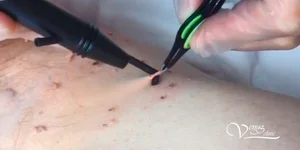 Удаление папиллом лазером