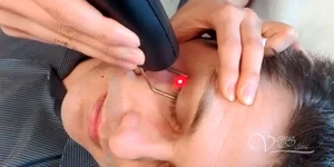 Ксантелазма удаление лазером