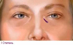 Носослезная борозда степень 1