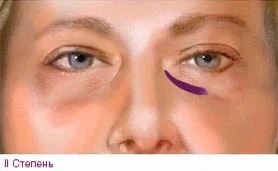 Носослезная борозда степень 2