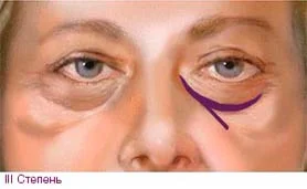 Носослезная борозда степень 3