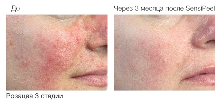 SensiPeel пилинг для чувствительной кожи результаты.