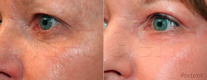 Морщины вокруг глаз коррекция азотной плазмой