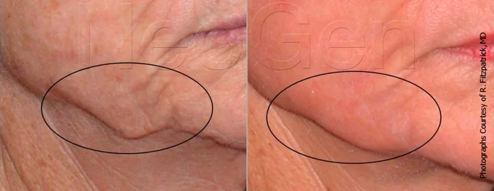 Коррекция овала лица азотной плазмой