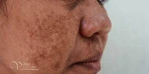 Мелазма на щеках у женщины