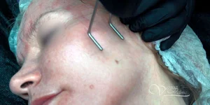 Шлифовка рубцов лазером