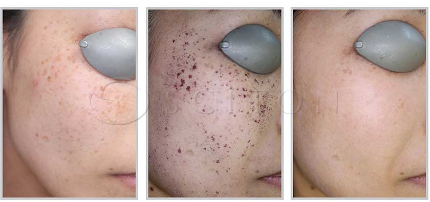 стадії відновлення шкіри після фотоомолодження BBL