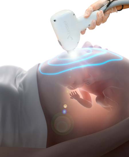 Лазерна епіляція при вагітності